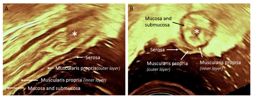Primer pas cap a l’estandardització de l’ecografia intraoperatòria en la cirurgia de l’endometriosi
